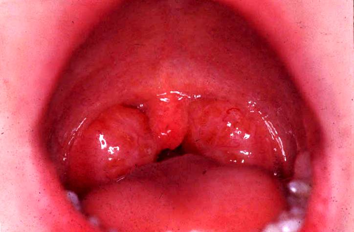 swollen tonsils